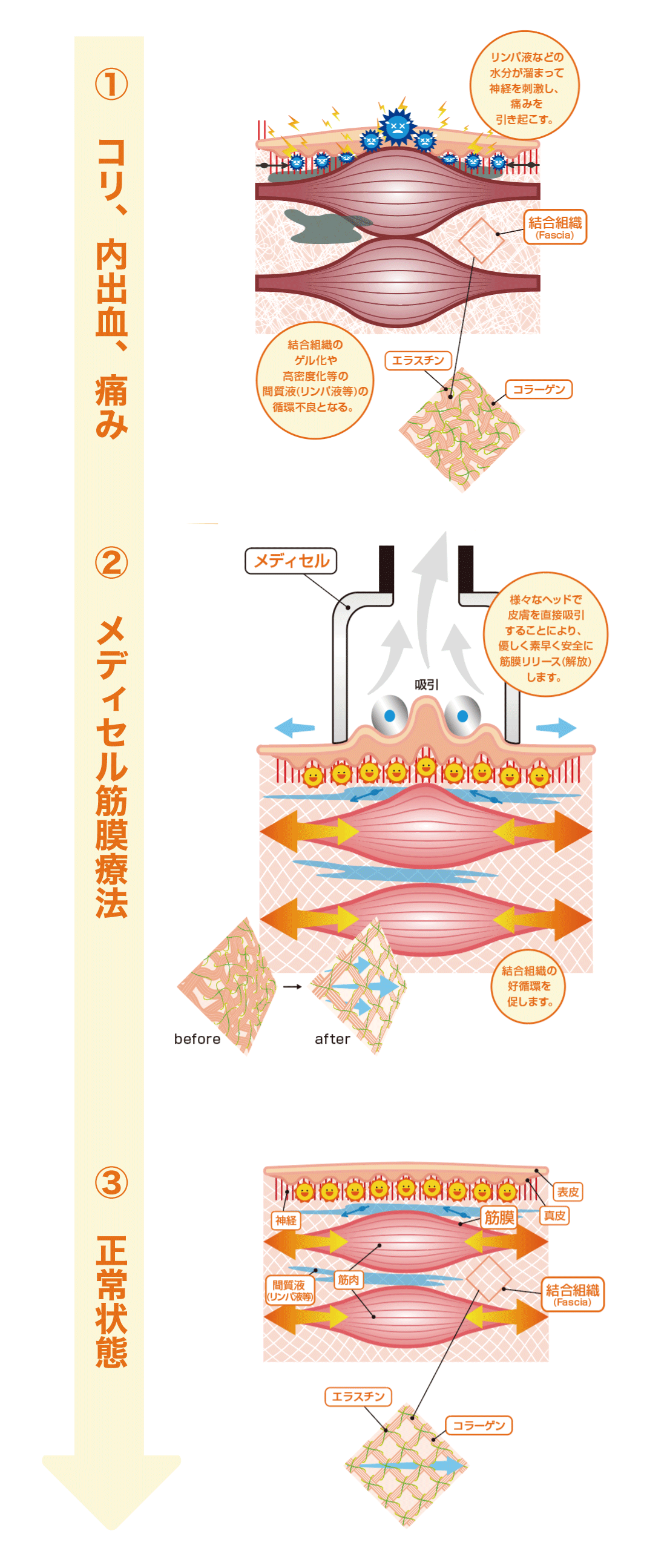 筋膜リリース メディセル筋膜療法